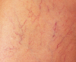 varicose-veins-on-the-thigh-of-a-woman-close-up.jpg