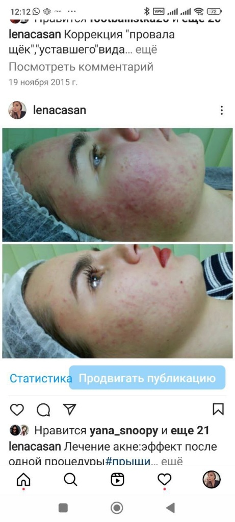Лечение акне, после первой процедуры - работа Елены Анатольевны