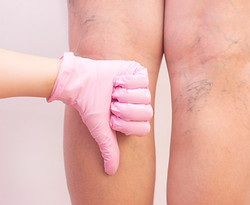 female-legs-with-varicose-veins (1).jpg