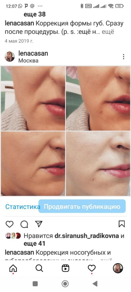 Коррекция носогубных и губоподбородочных складок - работа Елены Анатольевны