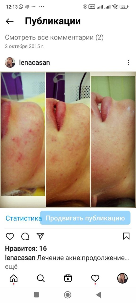 Лечение акне, после второй процедуры - работа Елены Анатольевны