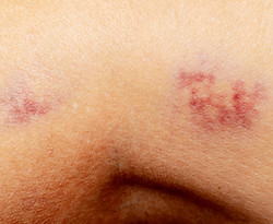 two-hematomas-on-the-leg-in-a-woman-domestic-violence.jpg